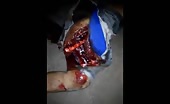 Guy got his leg amputated and arm chopped 16