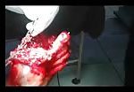 Crushed foot surgery 2