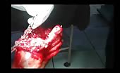 Crushed foot surgery 14