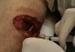 Man suffering from shrapnel wound 3