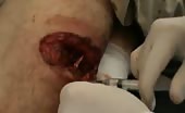 Man suffering from shrapnel wound 8