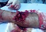 Severe leg wound 3