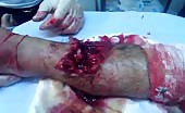 Severe leg wound 1