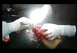 Severely damaged hand amputation in process 2