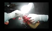 Severely damaged hand amputation in process 5