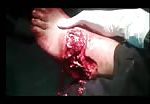 Nasty injuries in the foot 2