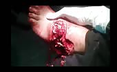 Nasty injuries in the foot 14