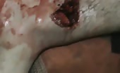Bullet shot in the leg 10