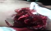 Man with arm ripped off and heart beating 2
