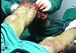 Men with multiple leg injuries 2