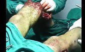 Men with multiple leg injuries 4