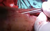 Removal of a metal plate from the leg 2