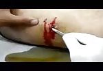 Retrieving metal object from injured leg 3