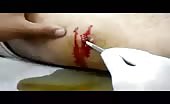 Retrieving metal object from injured leg 13