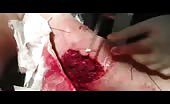Treatment of big wound in arm 4