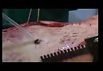 Operation of an open chest wound 1