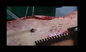 Operation of an open chest wound 10