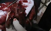 Severe hand injury with shrapnel 15