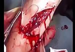 Suture process of brutally wounded leg 2