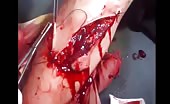 Suture process of brutally wounded leg 4
