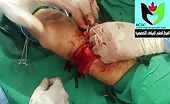 Amputation under the knee 9