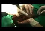 Amputation of hand in syrian war clinic 2