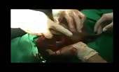 Amputation of hand in syrian war clinic 15