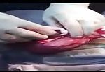 Huge kidney stones removed from bladder 1