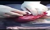 Huge kidney stones removed from bladder 3