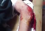Man with ripped elbow skin 2