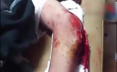 Man with ripped elbow skin 1