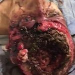 Woman's brain eaten by maggots while she suffer 3