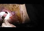 Extracting a metal fragment from wound 4