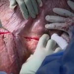 Testicle tumor removal surgery 3