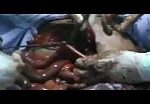 Graphic - surgery for an injured in his stomach 1