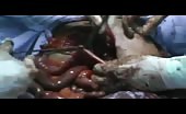 Graphic - surgery for an injured in his stomach 3
