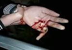 Injured hand with broken finger! 1