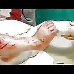 Amputation of the toes (child warning-graphic content) 1