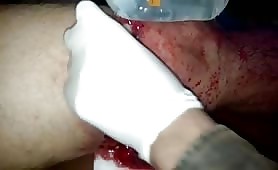 Gunshot wound to the thigh 14
