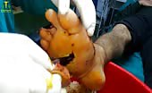 Severed foot and amputation of a middle finger 4