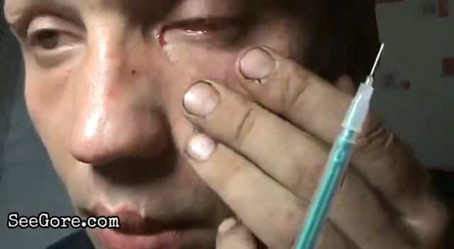 Man with Schizophrenia destroys his eye 1