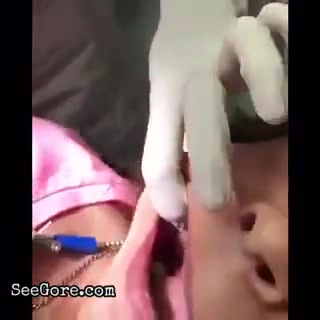 Teeth removal with pliers 10