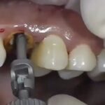 Pulling out a decayed tooth 1