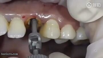 Pulling out a decayed tooth 3
