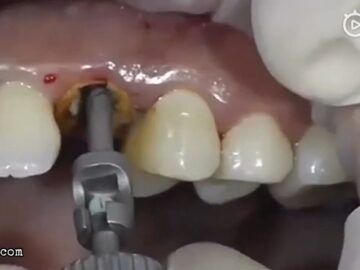 Pulling out a decayed tooth 6