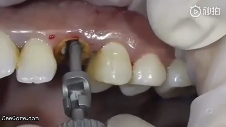 Pulling out a decayed tooth 13