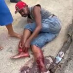 Man Tries to Reattach His Severed Foot 2