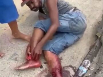 Man Tries to Reattach His Severed Foot 5