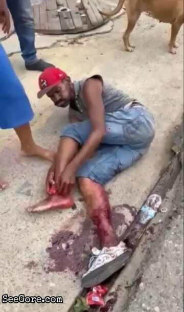 Man Tries to Reattach His Severed Foot 1