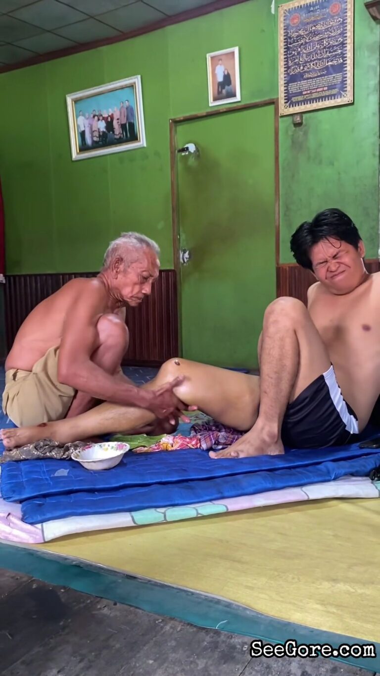 Indonesian Man Fixes Leg at Home 14
